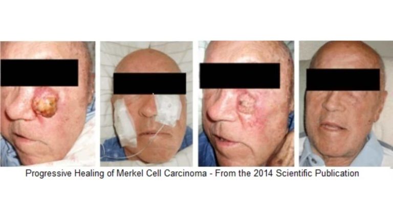 Merkel-Cell-Carcinoma