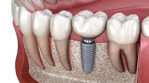 5 Benefits Of Dental Implants Over Dentures